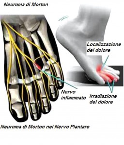 Mortons-neuroma-nerve-swelling